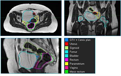 Deep Learning for Per-Fraction Automatic Segmentation of Gross Tumor Volume (GTV) and Organs at Risk (OARs) in Adaptive Radiotherapy of Cervical Cancer